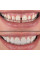 Знімні вініри каппи для зубів Perfect Smile Veneers білі